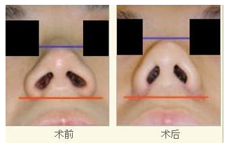 隆鼻术后会有疤痕吗