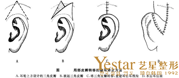 隐耳是什么样的？隐耳症能治吗？