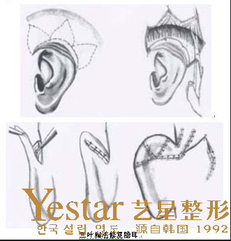 隐耳症会给患者造成什么影响