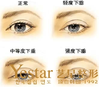  上睑下垂手术方法