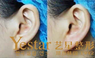 武汉玻尿酸丰耳垂疼吗