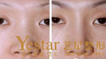 武汉隆鼻方法恢复时间短的是哪种