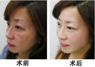 激光除黄褐斑价格