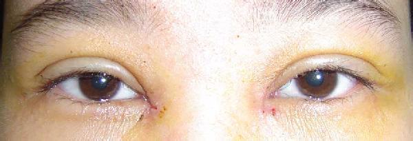 武汉双眼皮手术出现疤痕该怎么办?-yestar武汉