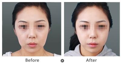 怎么瘦脸最有效的方法 a19a9111921e8fd61f083ba7cd163ac4.jpg