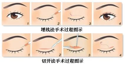 双眼皮手术图片