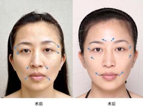 美容激光原理是什么意思_比基尼美容是什么意思(2)