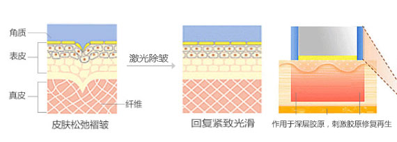 武汉激光除皱效果怎样