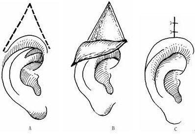 常用的有哪些隐耳整形手术