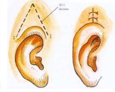 武汉外耳再造手术有效果吗