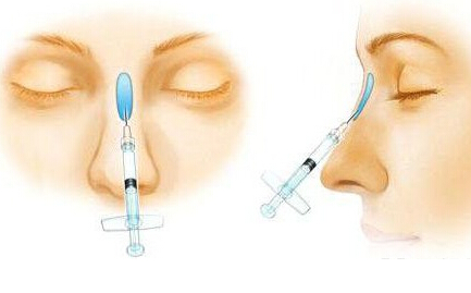 哪些材料可以注射隆鼻
