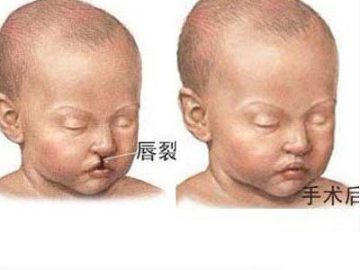 婴儿唇裂怎么进行手术