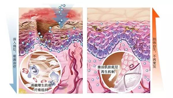 疤痕修复有什么方式