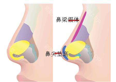 武汉取鼻假体效果好吗