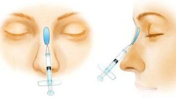 注射隆鼻效果能维持多久