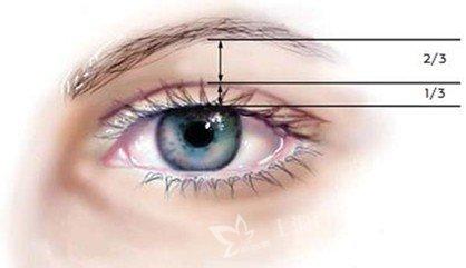 埋线双眼皮的效果能保持多久