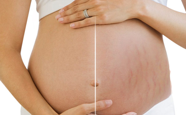 激光祛妊娠纹后有可能反弹吗