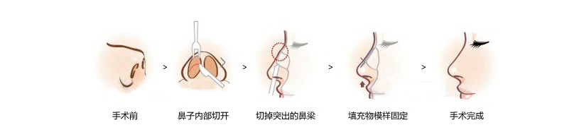 武汉驼峰鼻是怎么矫正的