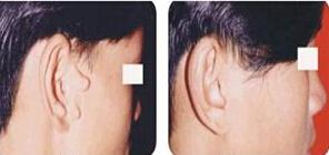 副耳切除手术是怎么做的呢