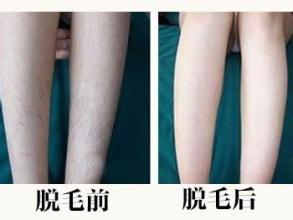 激光脱毛
