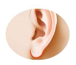 耳廓修复再造术前要注意什么
