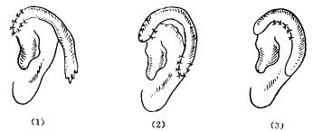 耳廓整形再造有什么方法呢