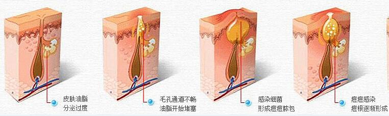 像素激光治疗痘痘后怎么恢复的