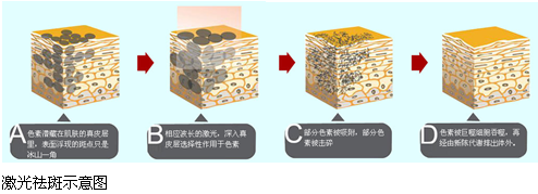 激光去斑