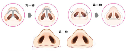 鼻翼缩小手术过程复杂吗