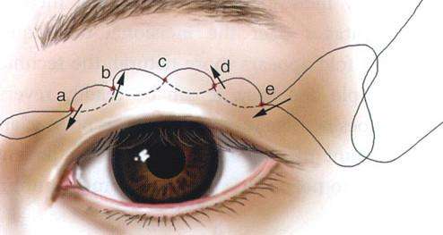埋线双眼皮后怎么护理