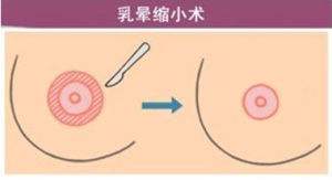 乳晕缩小术怎么做的