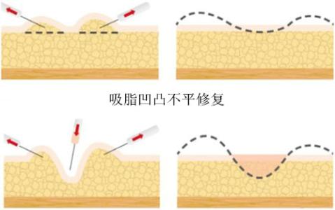 吸脂后凹凸不平怎么办