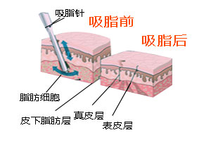 腰腹吸脂过程怎样的