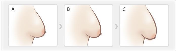 乳房下垂有什么原因