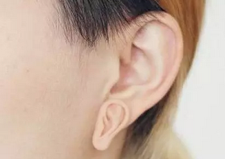 副耳切除会影响听力吗