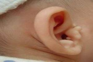 儿童做副耳切除有危险吗