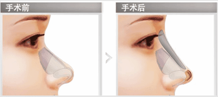 假体隆鼻优势是什么