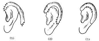 耳廓修复方法有哪些