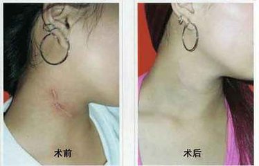 武汉激光祛外伤性疤痕要多少钱？