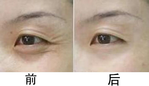 激光去鱼尾纹要注意什么