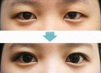割双眼皮