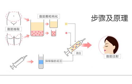 哪些部位可以填充自体脂肪