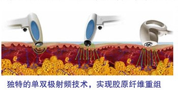 荆州射频除皱费用多少