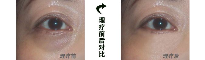 去黑眼圈
