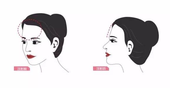 玻尿酸丰额头