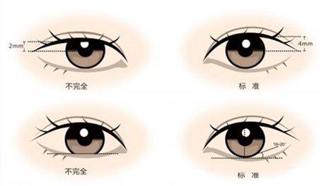 双眼皮
