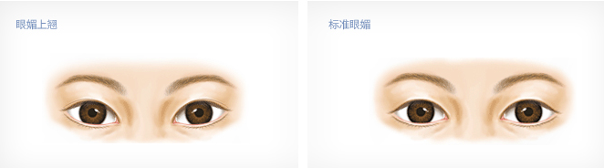 武汉做双眼皮手术大概要多少钱?