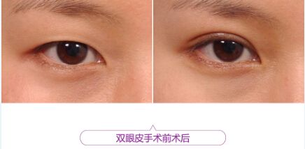 双眼皮