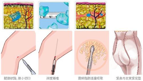 吸脂