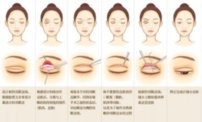 永康做双眼皮会留疤痕吗?